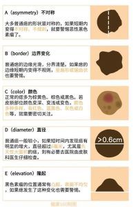 痣的分类成因与风险：警惕癌变，正确护理方法