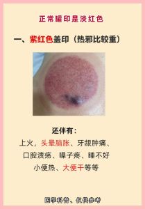 拔罐印色解析与安全注意