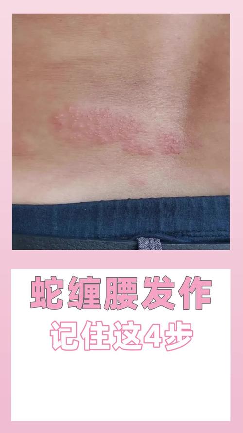 蛇缠腰揭秘：带状疱疹预防与治疗方法