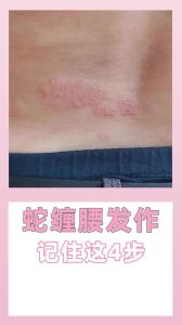 蛇缠腰揭秘：带状疱疹预防与治疗方法