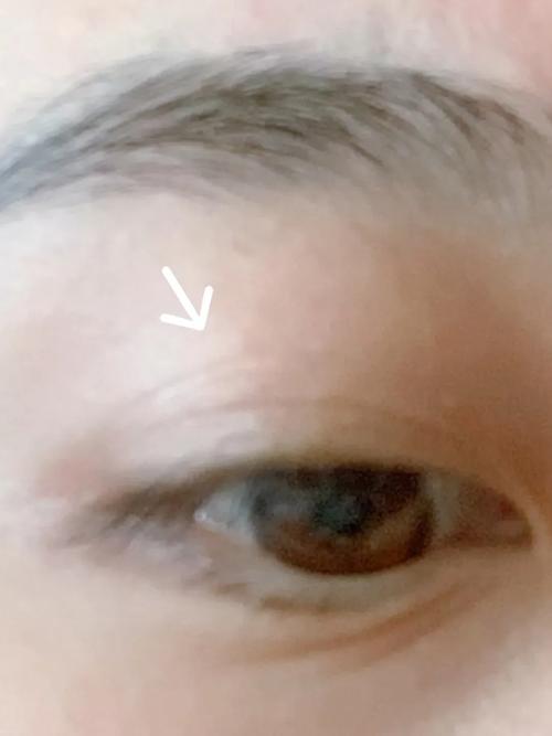 揭秘右眼上眼皮抽搐：原因及治疗策略