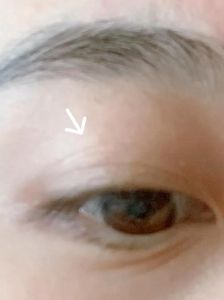 揭秘右眼上眼皮抽搐：原因及治疗策略