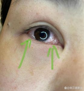 揭秘眼胀痛与眼球突出：多种原因及应对策略
