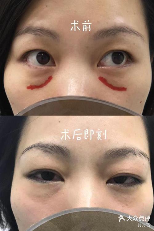 揭秘右眼下眼袋抽搐：健康信号与护理方法