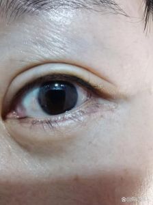 揭秘右眼下眼袋抽搐：成因及缓解方法！