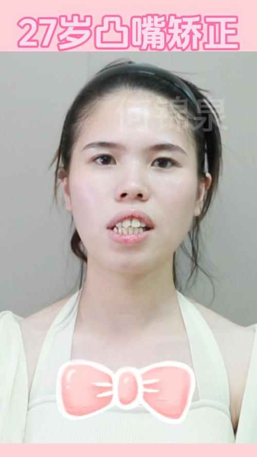 一年蜕变记：从骨性凸嘴到自信微笑
