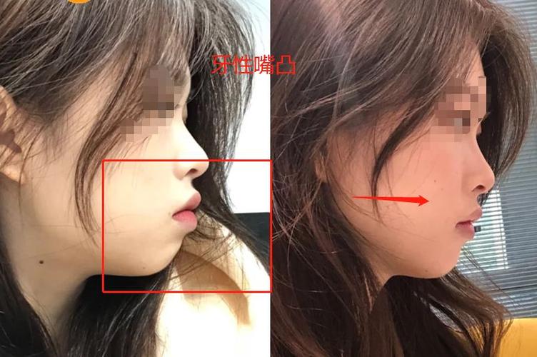 一年蜕变记：从骨性凸嘴到自信微笑