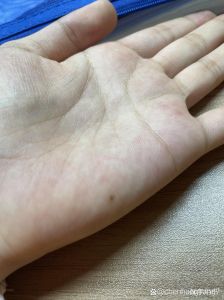揭秘手部活动受限原因及治疗护理方法