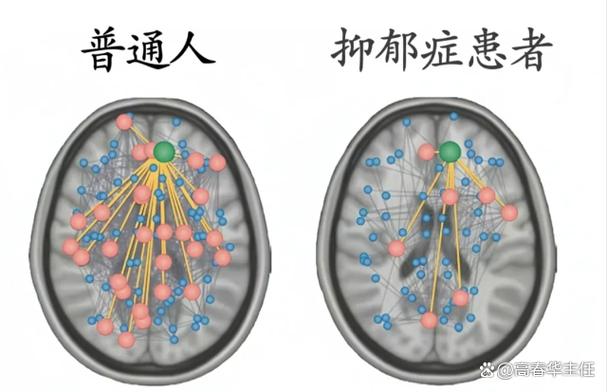 揭秘：抑郁症如何悄悄改变大脑，如何保卫大脑健康？