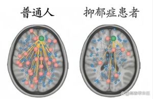 揭秘：抑郁症如何悄悄改变大脑，如何保卫大脑健康？