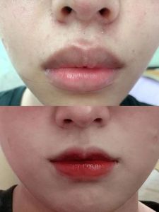 厚唇改薄风险避免术后后悔指南