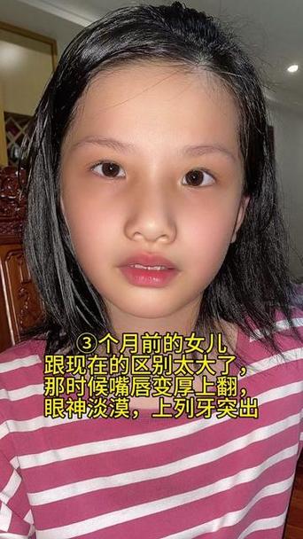 上嘴唇厚翘改善方法大！