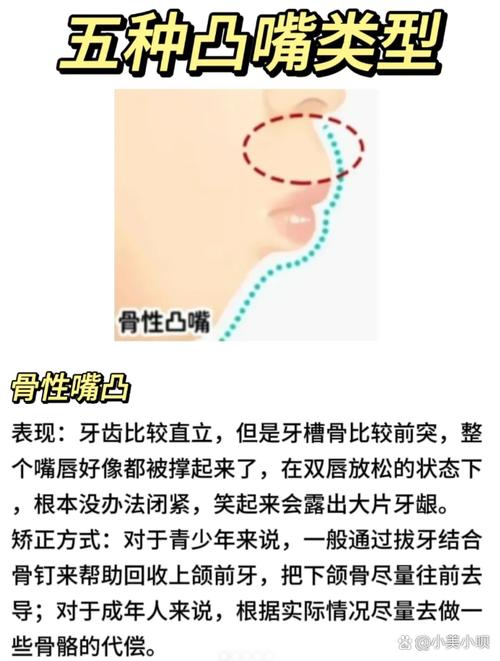 嘴巴突出矫正全攻略：选择最适合你的方法！