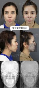 重塑微笑：凸嘴改善之道，自然与心理调适并重