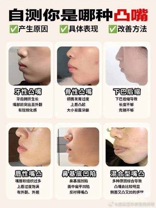 矫正凸嘴攻略：全方位方案与注意事项