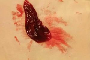 梦境解析：排出血块的深层含义及应对策略
