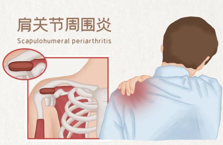 肩部疼痛及活动受限？成因与治疗方法