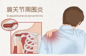 肩部疼痛及活动受限？成因与治疗方法