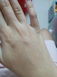 手背水肿：健康信号与治疗指南