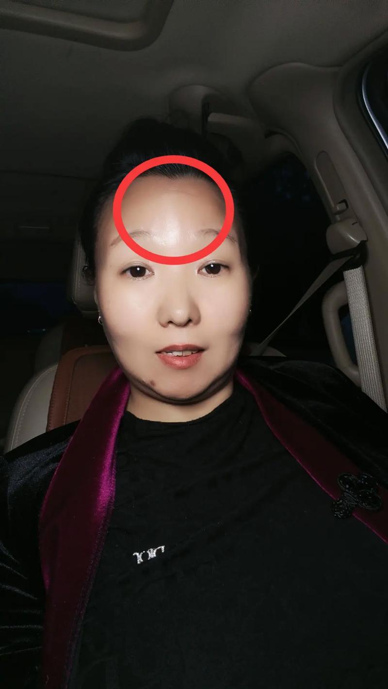 额头胎记：相学与心理解读，影响命运与心理之谜