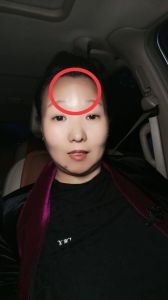 额头胎记：相学与心理解读，影响命运与心理之谜
