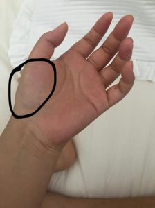 手指受限疼痛原因与缓解方法