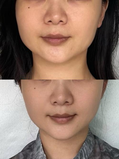 苹果肌填充长效秘诀：脂肪还是玻尿酸？持久保养指南