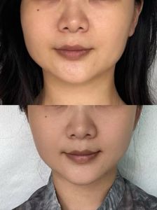 苹果肌填充长效秘诀：脂肪还是玻尿酸？持久保养指南