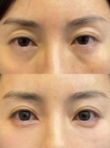 60岁抗皱秘诀大！无皱美丽人生指南