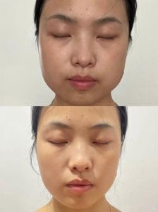 瘦脸针后遗症修复：三年蜕变，重拾完美脸型秘诀！