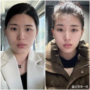 瘦脸针风险如何避免五官变化与面部僵硬