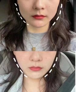 瘦脸针效果维持反弹与护理全解析
