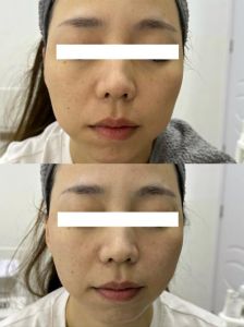 面部提升方案手术与非手术对比指南