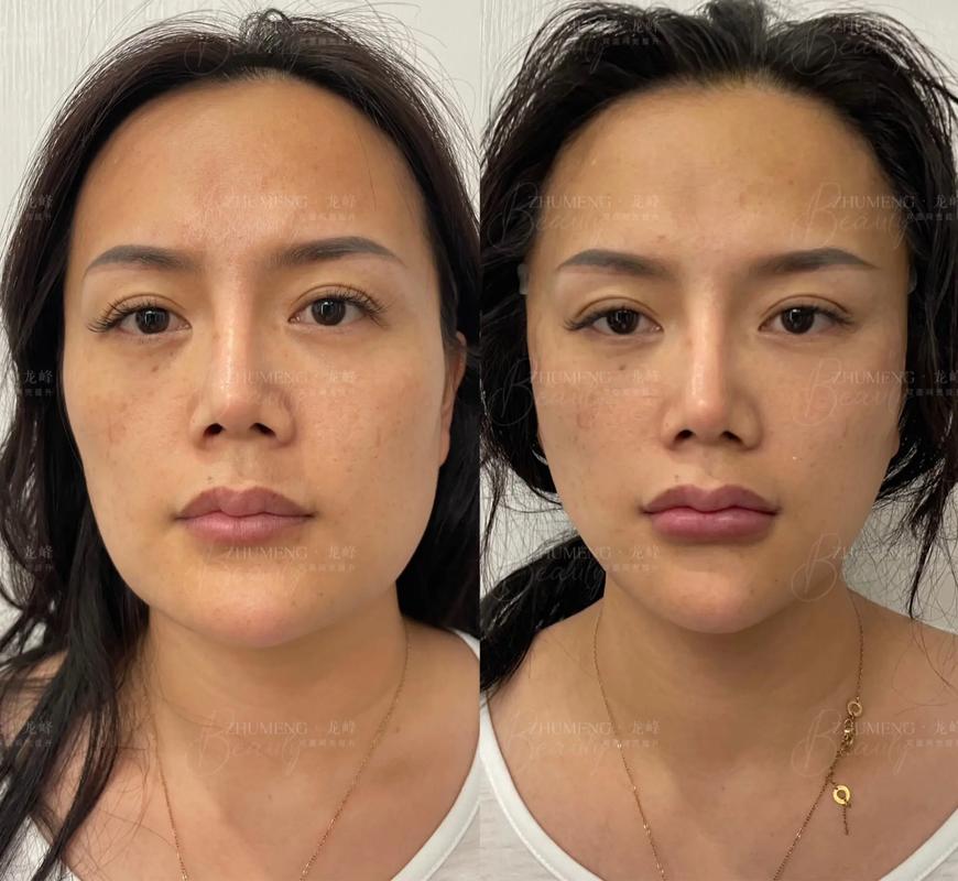 面部提升项目指南：轻松告别松弛，重拾青春！