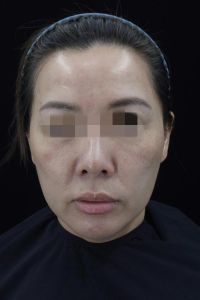 面部肌肉断层凹陷成因及治疗全解析