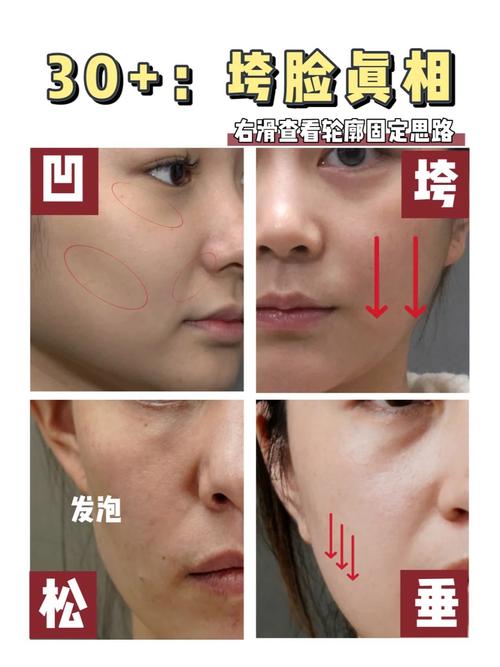 面部肌肉断层凹陷成因及治疗全解析