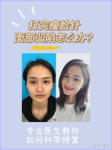 脸部凹陷恢复攻略：全方位治疗方法