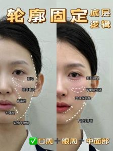 逆袭面部塌陷自体脂肪填充+玻尿酸，重拾年轻饱满面容