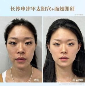 医美陷阱太阳凹陷填充风险与应对攻略