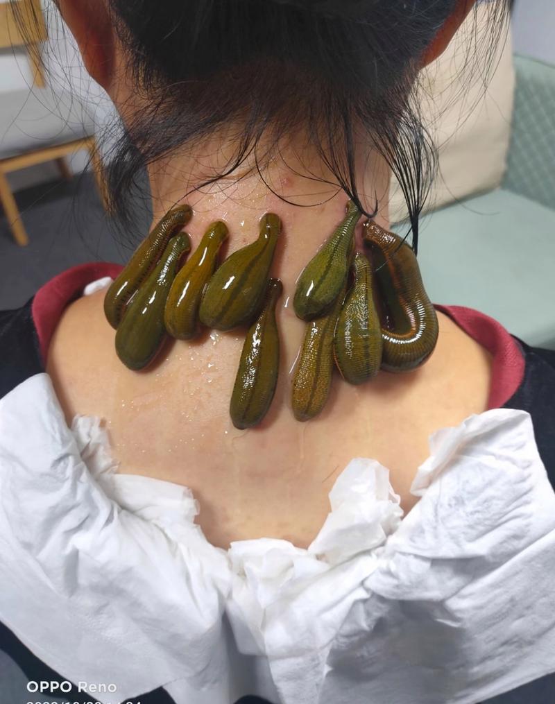 解梦水蛭消失的梦境意义