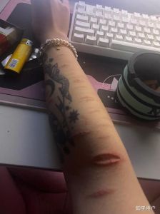 自残女孩心理：关爱与成长之路