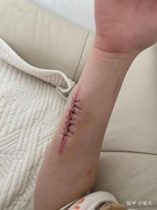 自残与青少年抑郁症：治疗方法与认识提升