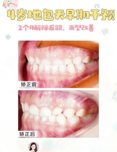 儿童结巴矫正全攻略：心理语言药物手术全方位应对