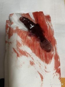 梦境解析：流产血迹的深层含义