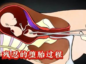 梦境堕胎：财运事业人际健康暗示解析