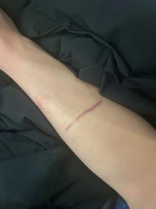 自残：心理挣扎与生理反应背后的痛苦
